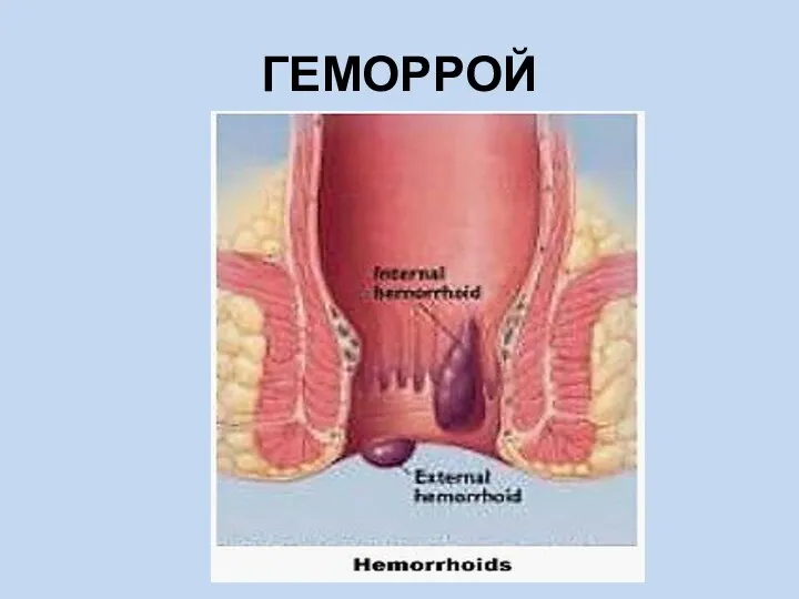 ГЕМОРРОЙ