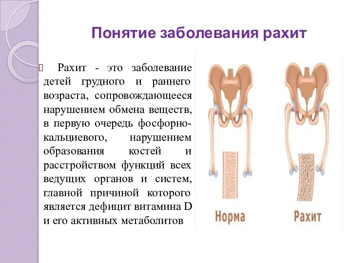 Понятие заболевания рахит Рахит - это заболевание детей грудного и раннего возраста,