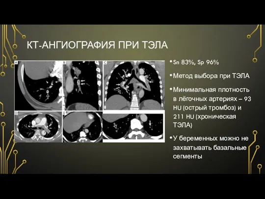 КТ-АНГИОГРАФИЯ ПРИ ТЭЛА Sn 83%, Sp 96% Метод выбора при ТЭЛА Минимальная