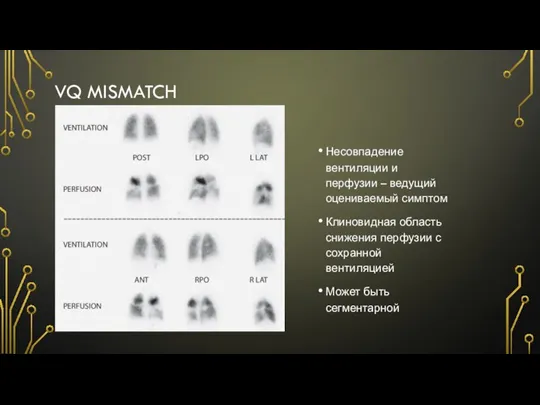 VQ MISMATCH Несовпадение вентиляции и перфузии – ведущий оцениваемый симптом Клиновидная область