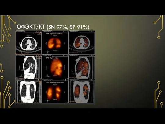 ОФЭКТ/КТ (SN 97%, SP 91%)