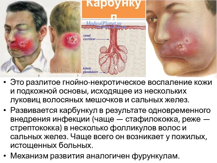 Карбункул Это разлитое гнойно-некротическое воспаление кожи и подкожной основы, исходящее из нескольких