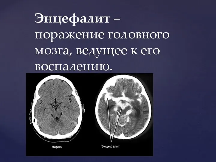 Энцефалит – поражение головного мозга, ведущее к его воспалению.