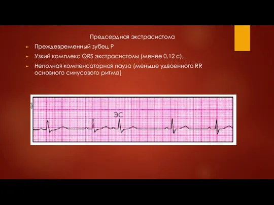 Предсердная экстрасистола Преждевременный зубец Р Узкий комплекс QRS экстрасистолы (менее 0,12 с),