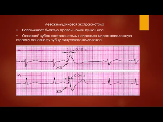 Левожелудочковая экстрасистола • Напоминает блокаду правой ножки пучка Гиса • Основной зубец