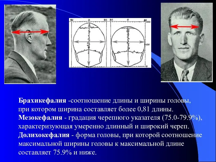 Брахикефалия -соотношение длины и ширины головы, при котором ширина составляет более 0,81