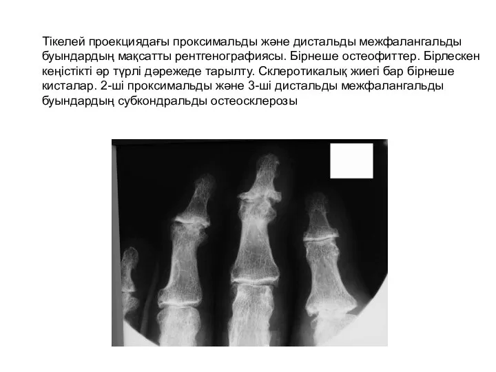 Тікелей проекциядағы проксимальды және дистальды межфалангальды буындардың мақсатты рентгенографиясы. Бірнеше остеофиттер. Бірлескен