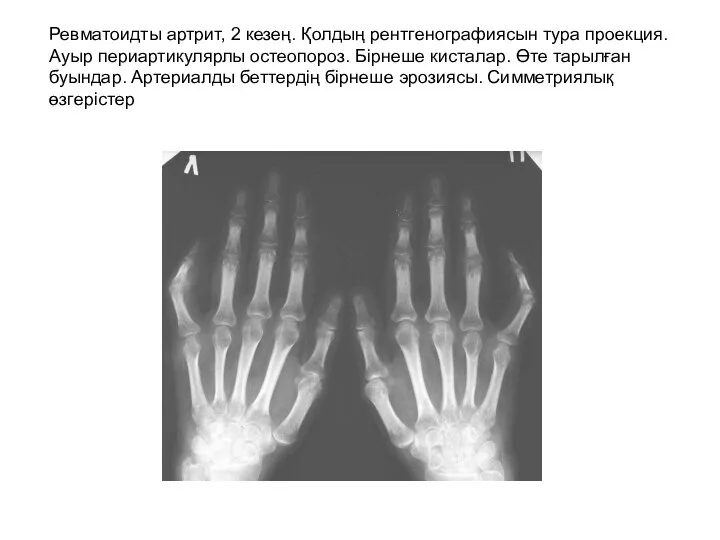 Ревматоидты артрит, 2 кезең. Қолдың рентгенографиясын тура проекция. Ауыр периартикулярлы остеопороз. Бірнеше