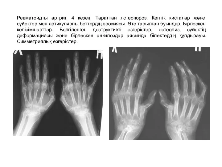 Ревматоидты артрит, 4 кезең. Таралған лстеопороз. Көптік кисталар және сүйектер мен артикулярлы