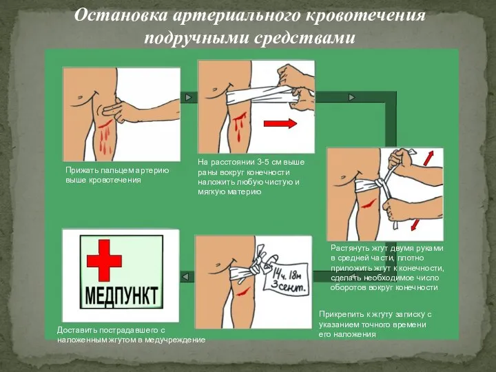 Остановка артериального кровотечения подручными средствами Прижать пальцем артерию выше кровотечения На расстоянии