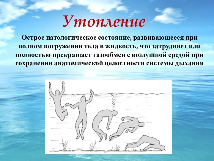 Утопление Острое патологическое состояние, развивающееся при полном погружении тела в жидкость, что