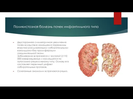 Поликистозная болезнь почек инфантильного типа Двустороннее симметричное увеличение почек вследствие замещения паренхимы
