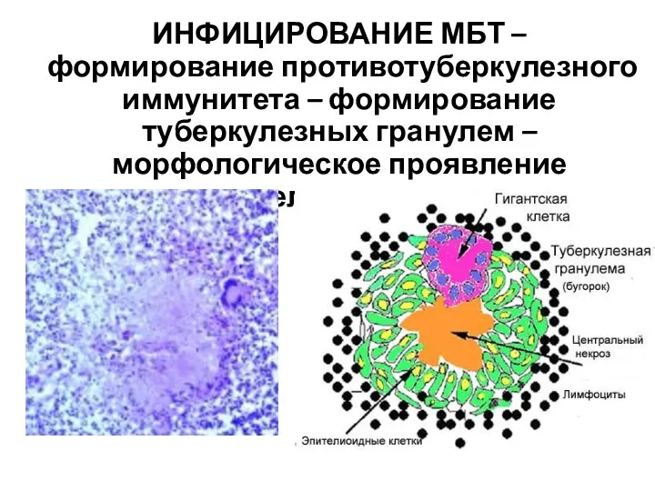 ИНФИЦИРОВАНИЕ МБТ – формирование противотуберкулезного иммунитета – формирование туберкулезных гранулем – морфологическое проявление гиперчувствительности замедленного типа