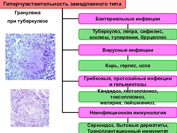 Гранулема при туберкулезе