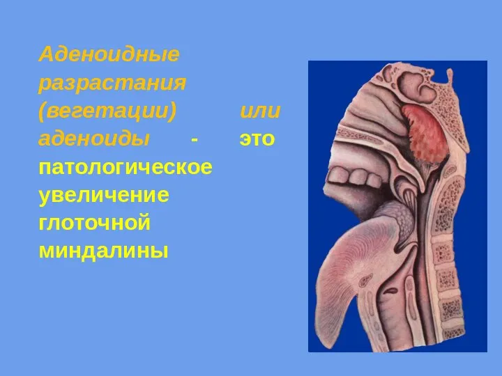 Аденоидные разрастания (вегетации) или аденоиды - это патологическое увеличение глоточной миндалины