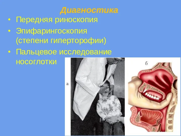 Диагностика Передняя риноскопия Эпифарингоскопия (степени гиперторофии) Пальцевое исследование носоглотки