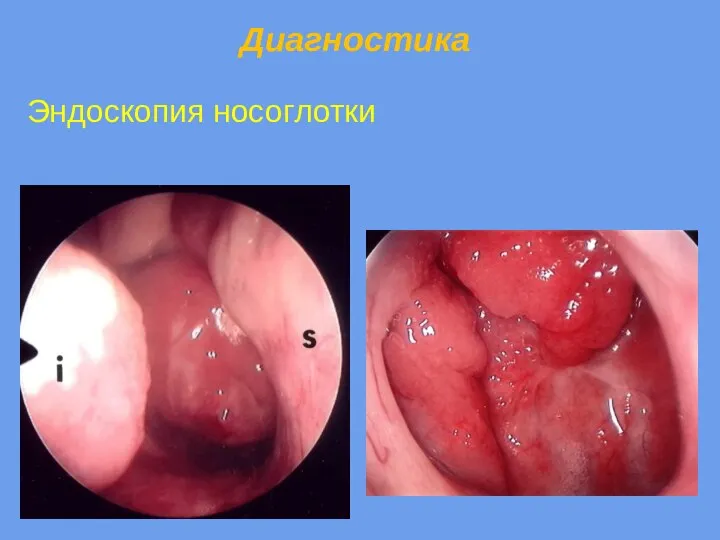 Диагностика Эндоскопия носоглотки