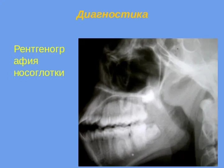 Диагностика Рентгенография носоглотки