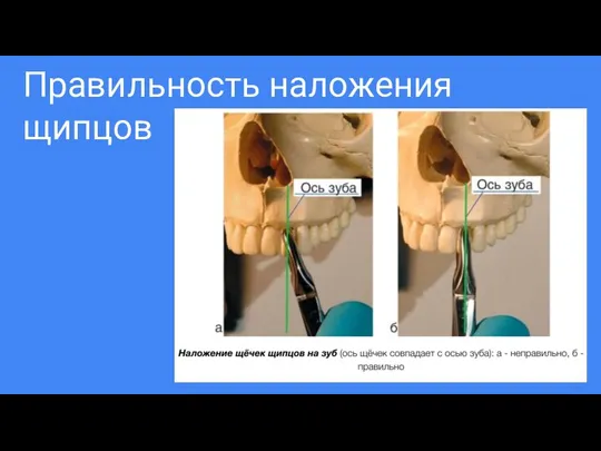 Правильность наложения щипцов