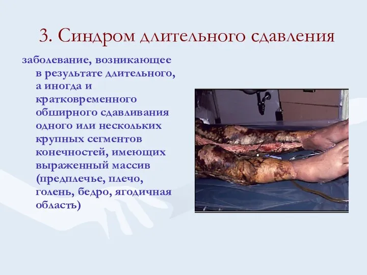 3. Синдром длительного сдавления заболевание, возникающее в результате длительного, а иногда и