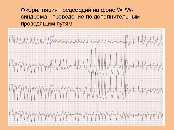 Фибрилляция предсердий на фоне WPW-синдрома - проведение по дополнительным проводящим путям.