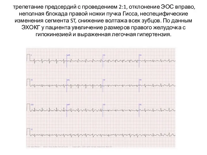 трепетание предсердий с проведением 2:1, отклонение ЭОС вправо, неполная блокада правой ножки