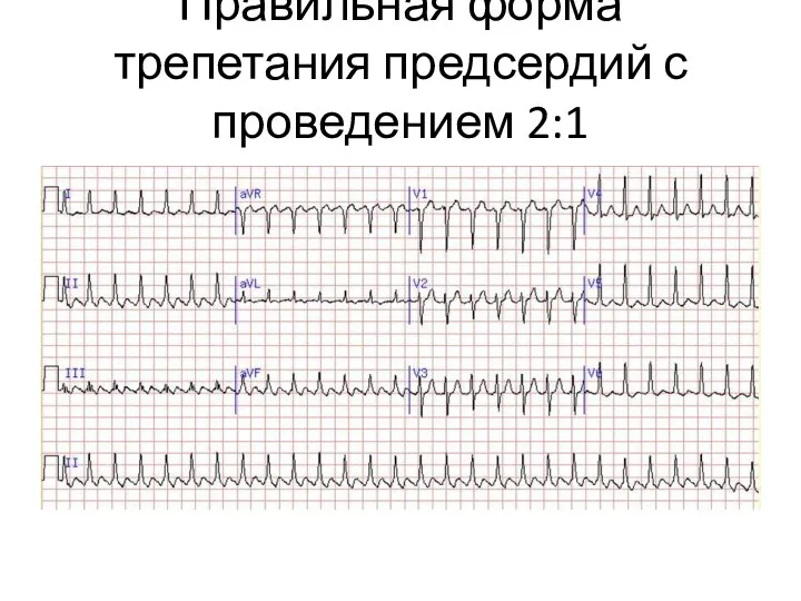 Правильная форма трепетания предсердий с проведением 2:1