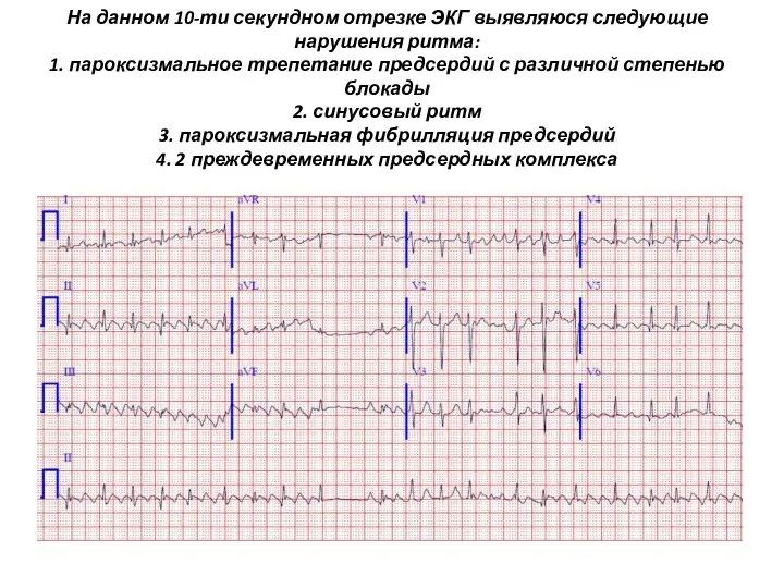 На данном 10-ти секундном отрезке ЭКГ выявляюся следующие нарушения ритма: 1. пароксизмальное