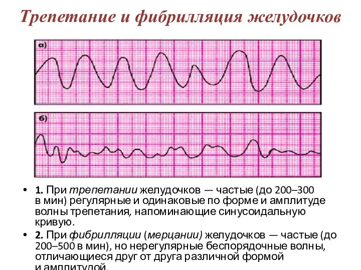 Трепетание и фибрилляция желудочков 1. При трепетании желудочков — частые (до 200–300
