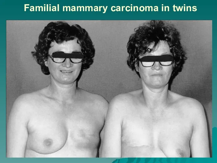 Familial mammary carcinoma in twins