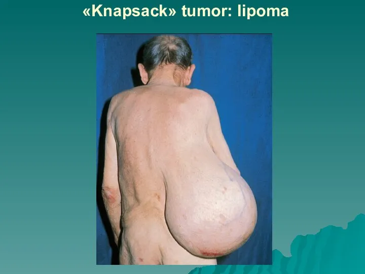 «Knapsack» tumor: lipoma
