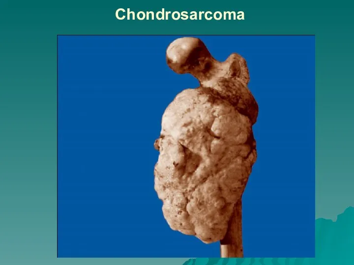 Chondrosarcoma