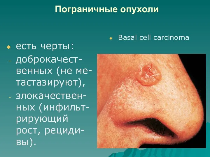 Пограничные опухоли есть черты: доброкачест-венных (не ме-тастазируют), злокачествен-ных (инфильт-рирующий рост, рециди-вы). Basal cell carcinoma