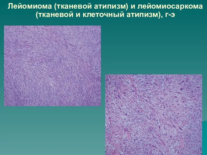 Лейомиома (тканевой атипизм) и лейомиосаркома (тканевой и клеточный атипизм), г-э