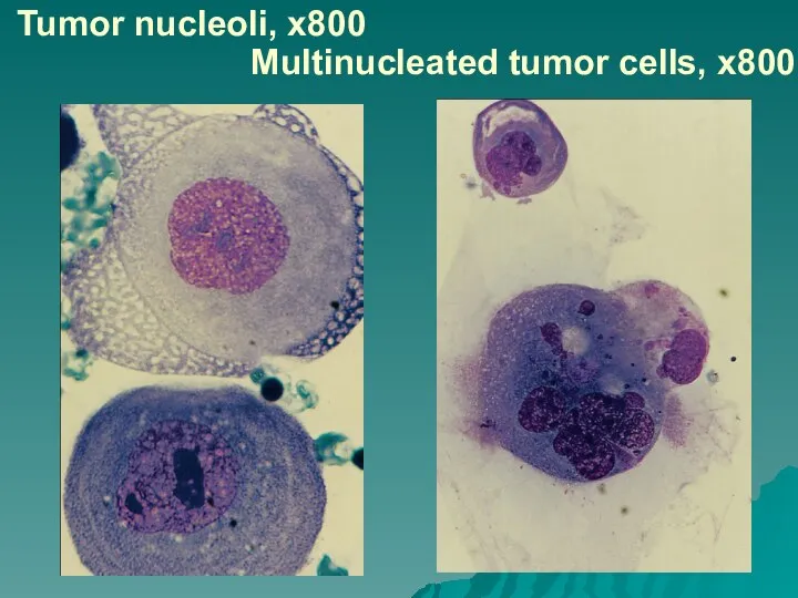 Tumor nucleoli, x800 Multinucleated tumor cells, х800