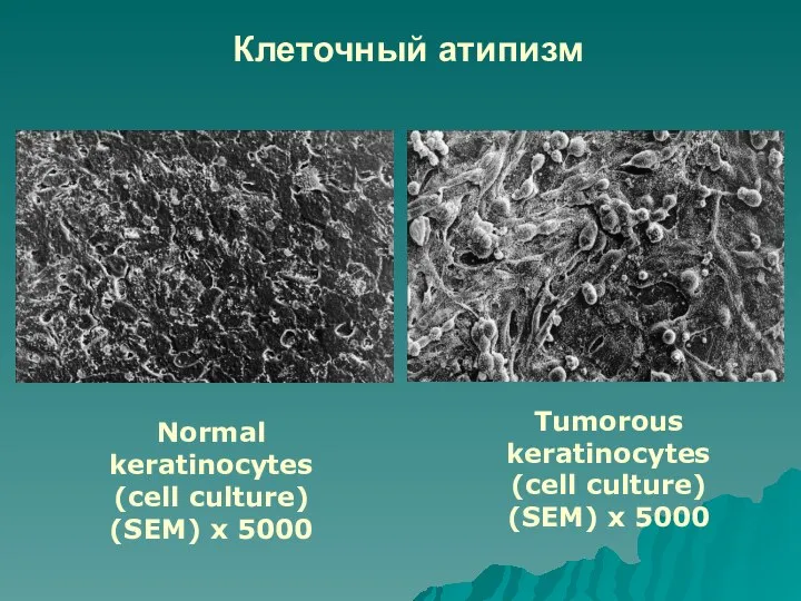 Клеточный атипизм Tumorous keratinocytes (cell culture) (SEM) x 5000 Normal keratinocytes (cell culture) (SEM) x 5000