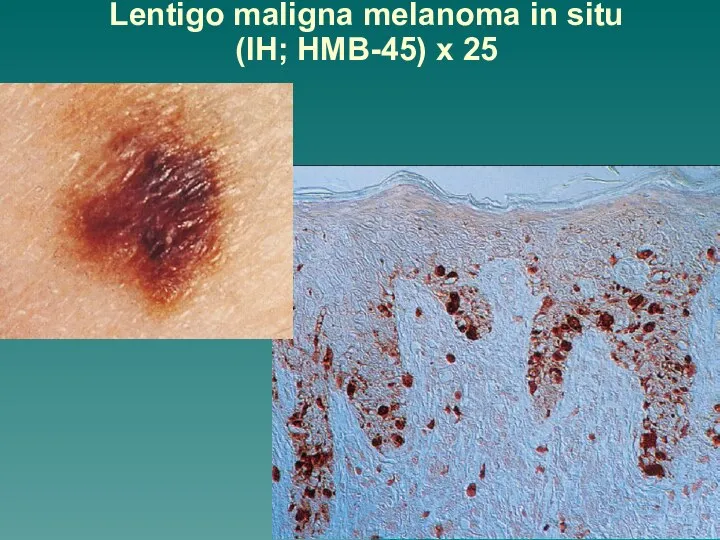 Lentigo maligna melanoma in situ (IH; HMB-45) x 25