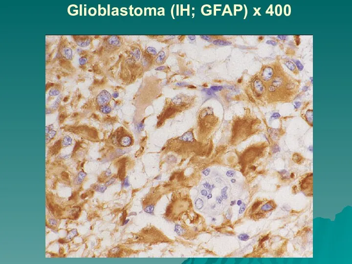 Glioblastoma (IH; GFAP) x 400