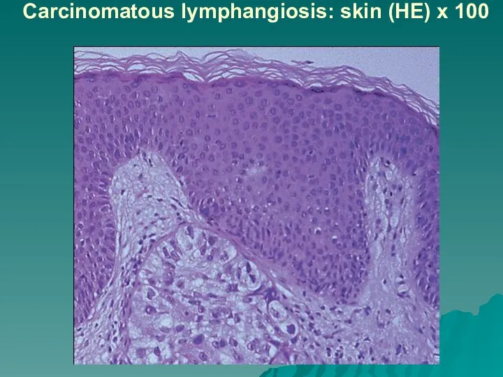 Carcinomatous lymphangiosis: skin (HE) x 100