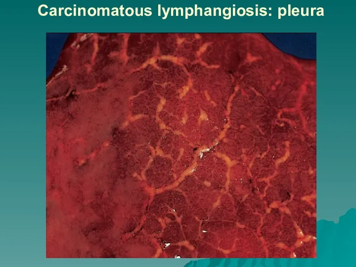 Carcinomatous lymphangiosis: pleura