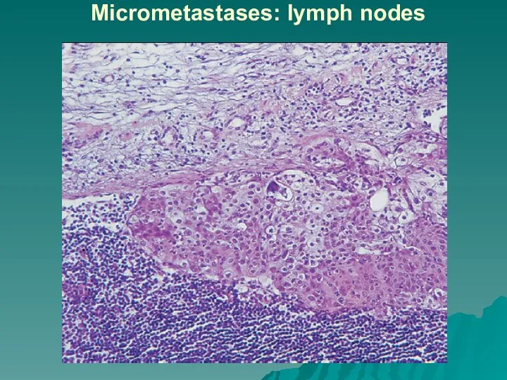 Micrometastases: lymph nodes