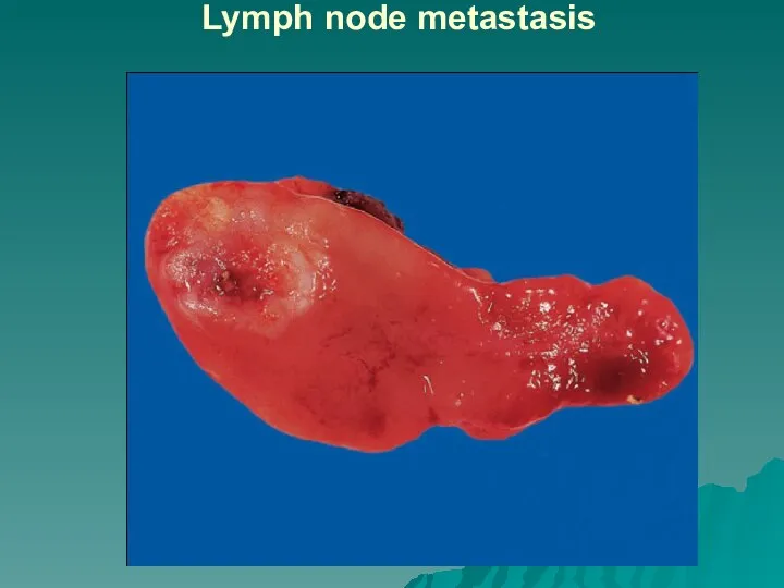 Lymph node metastasis