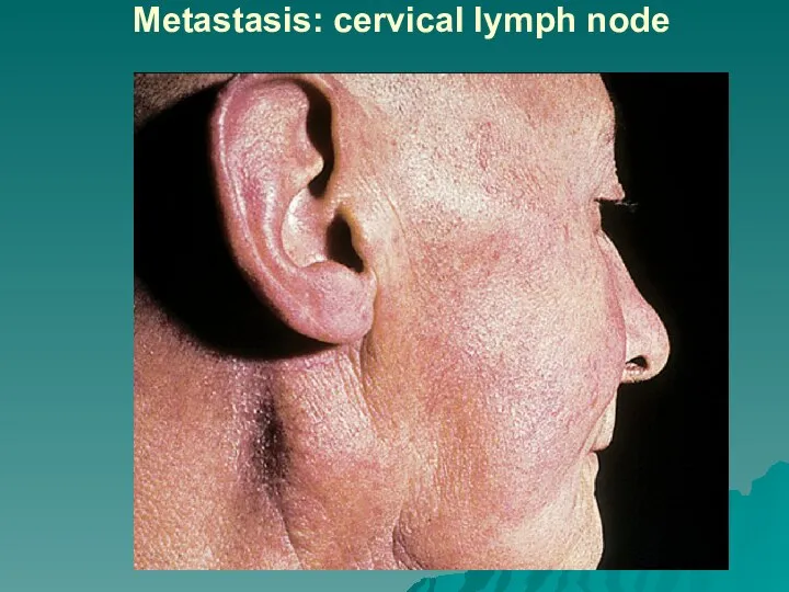 Metastasis: cervical lymph node