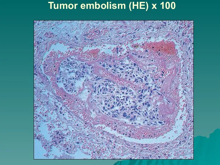 Tumor embolism (HE) x 100