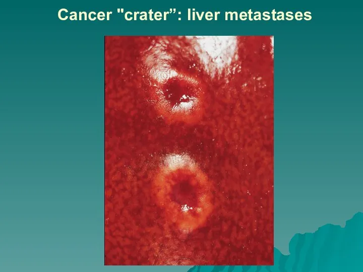 Cancer "crater”: liver metastases