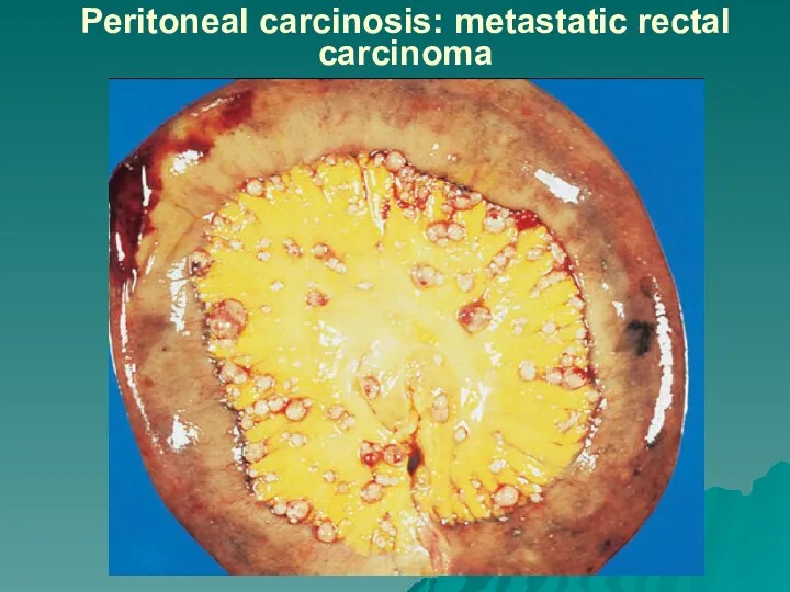 Peritoneal carcinosis: metastatic rectal carcinoma