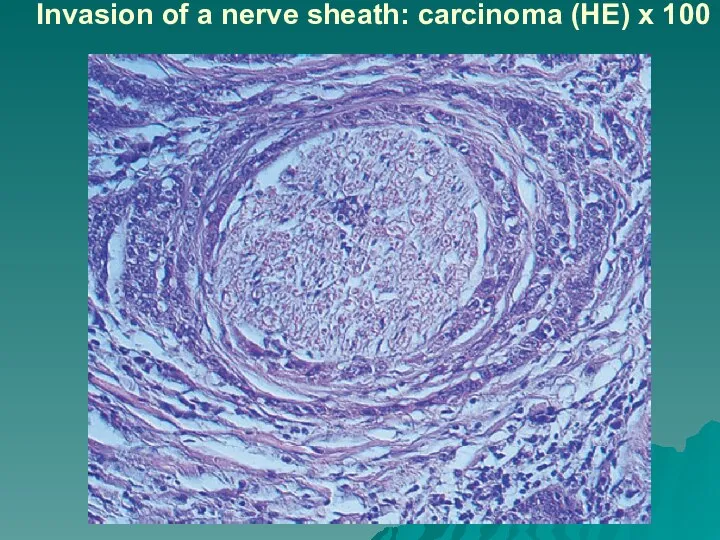 Invasion of a nerve sheath: carcinoma (HE) x 100