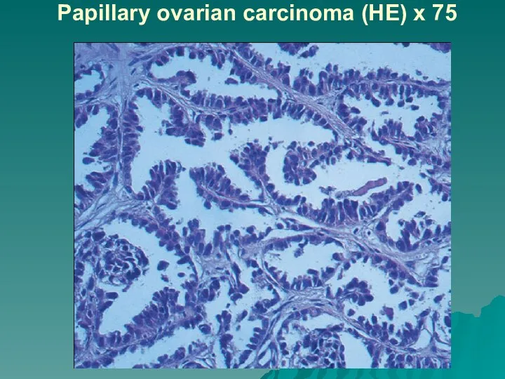 Papillary ovarian carcinoma (HE) x 75