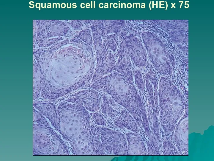 Squamous cell carcinoma (HE) x 75