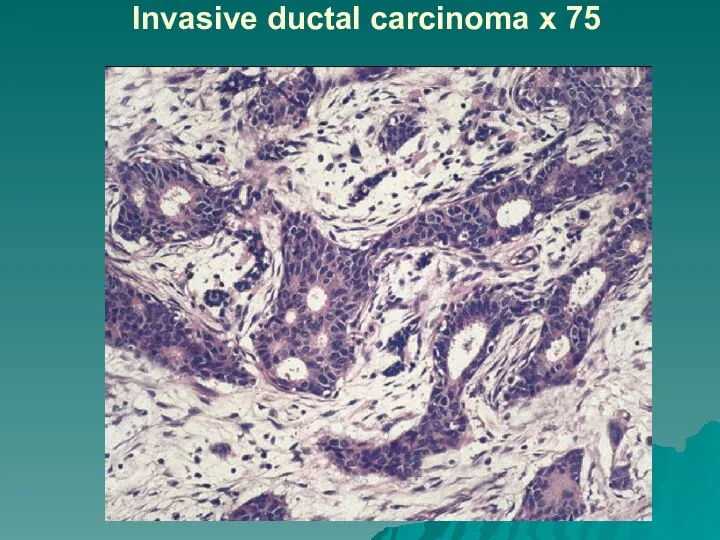 Invasive ductal carcinoma x 75